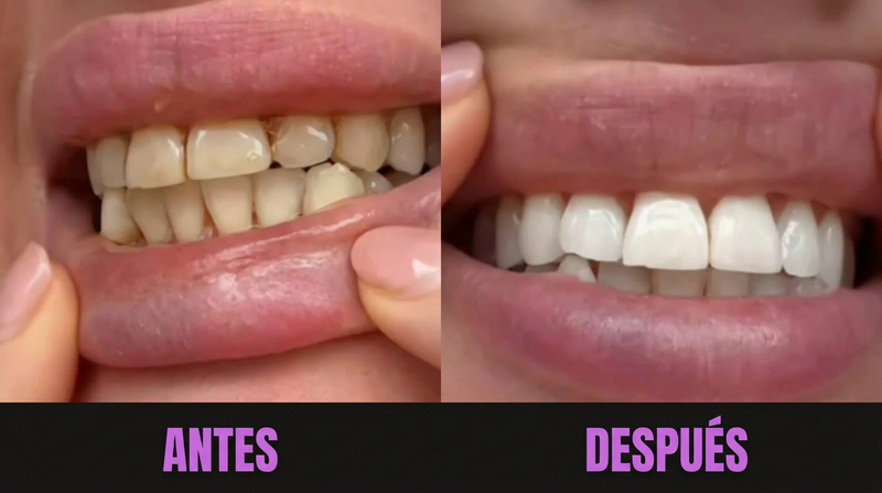 Comparación antes y después de usar LUMORA Purple Whitening Strips