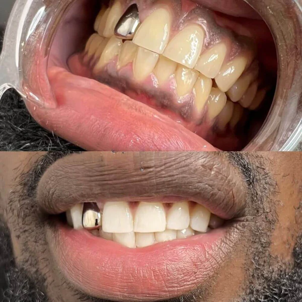 Mujer sonriendo después del tratamiento LUMORA V34